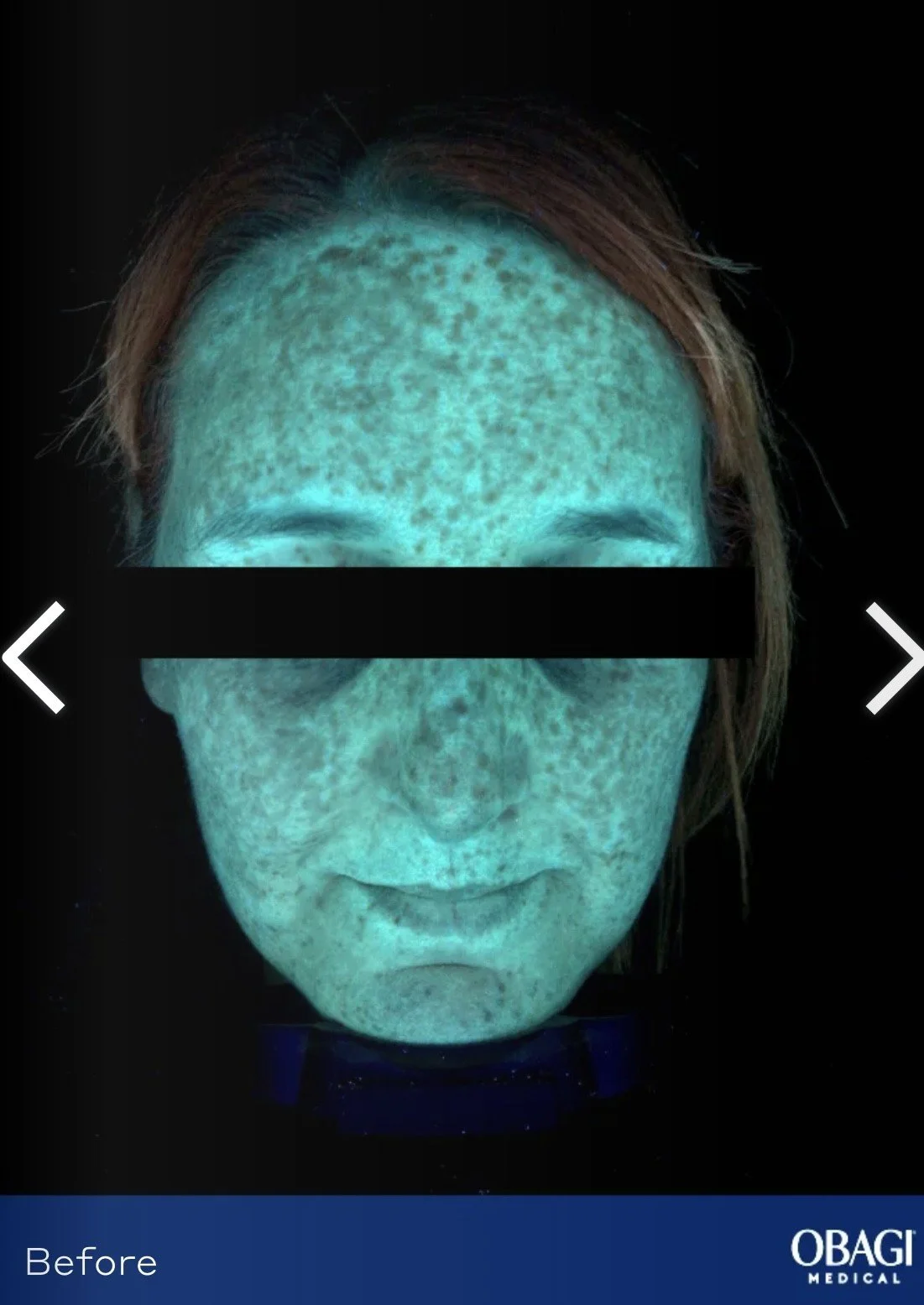 A person's face is illuminated by a blacklight, revealing freckles on the skin. The person's eyes are obscured by a black bar, and their hair is partially visible. The image appears to be a medical skin assessment under ultraviolet light.