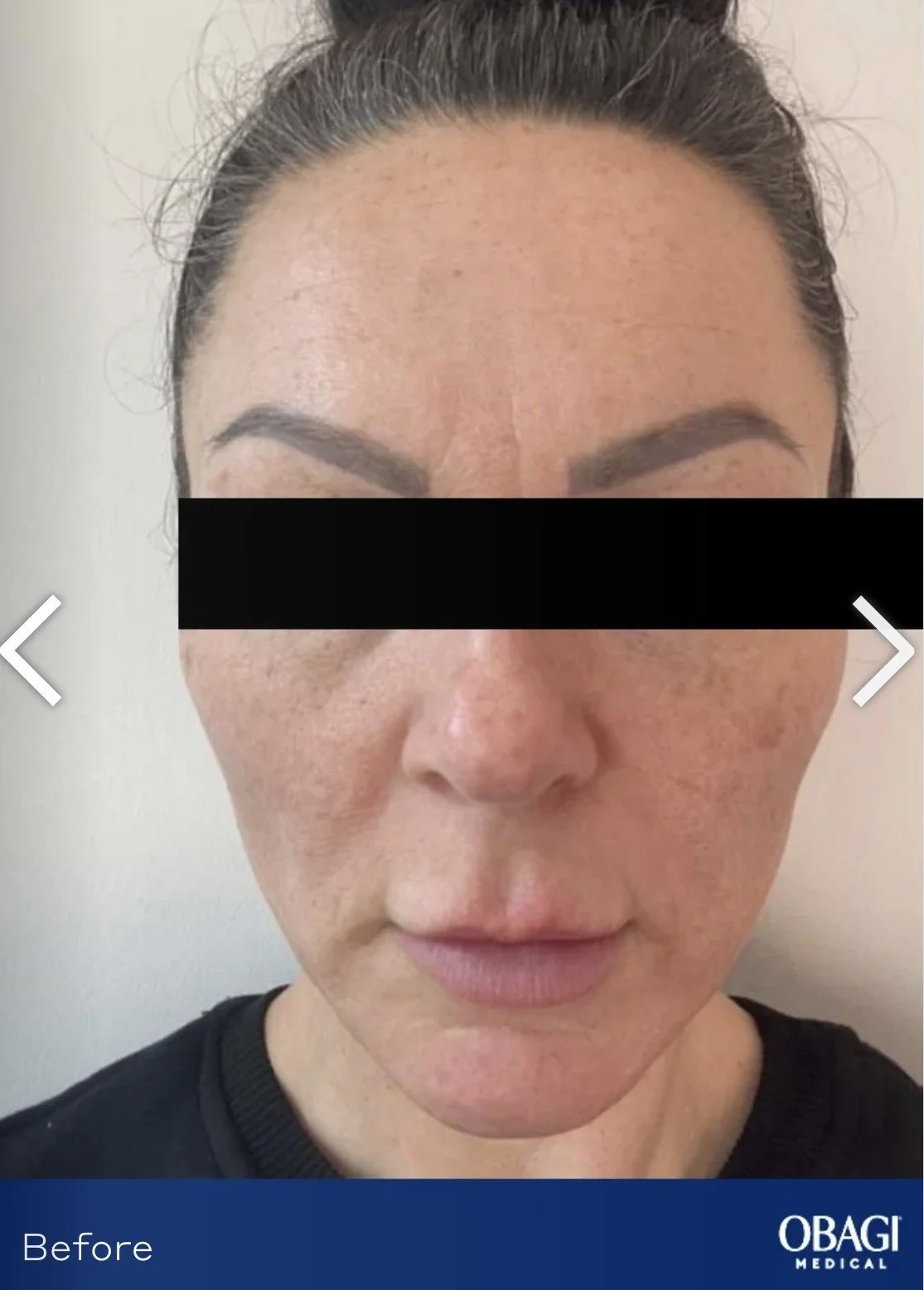 Close-up of a woman's face showing a before image of her skin with some uneven texture and redness, with a black bar covering her eyes for anonymity, and her face is slightly tilted downward.