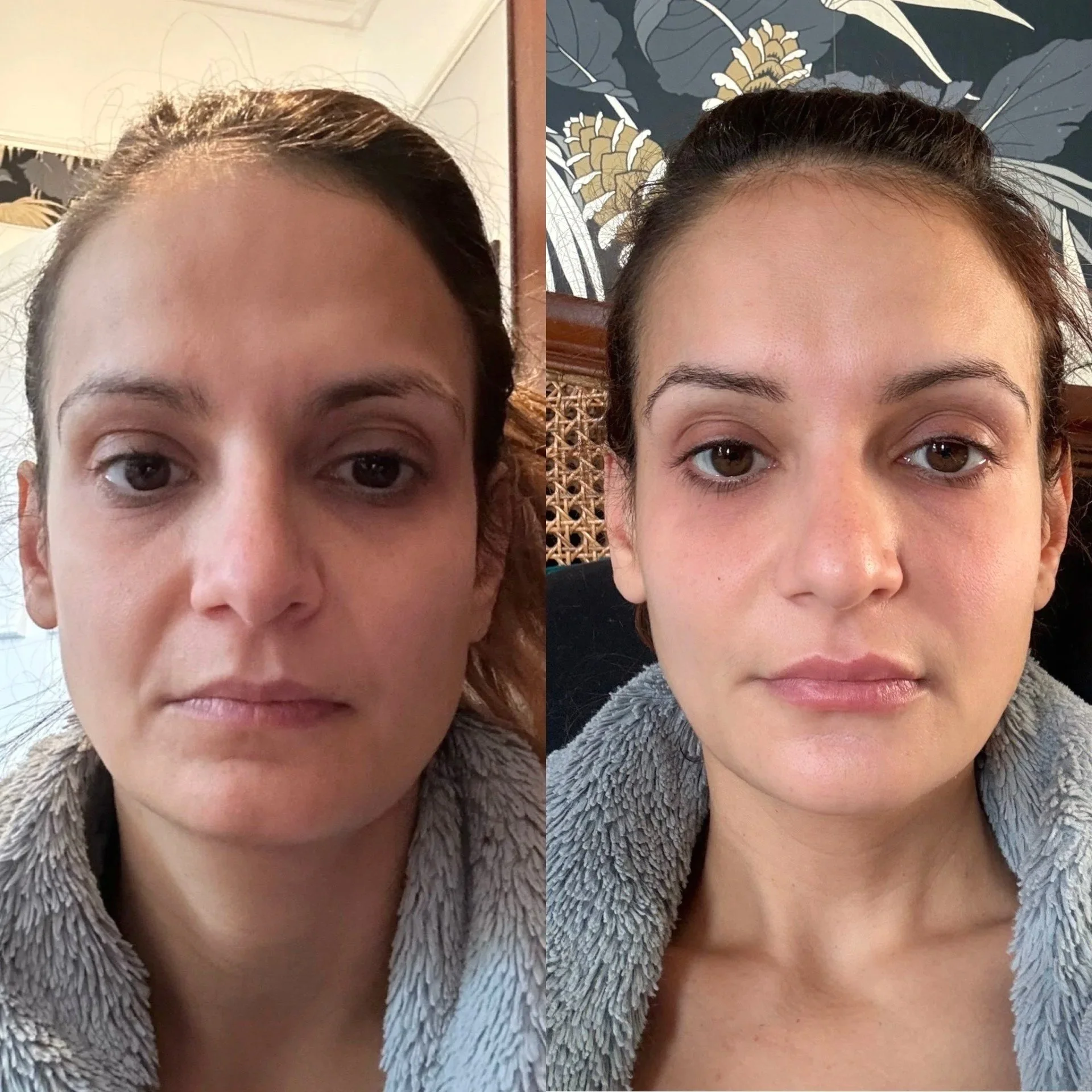 Before and after showing long-term improvement in skin quality, pigmentation and natural facial balance