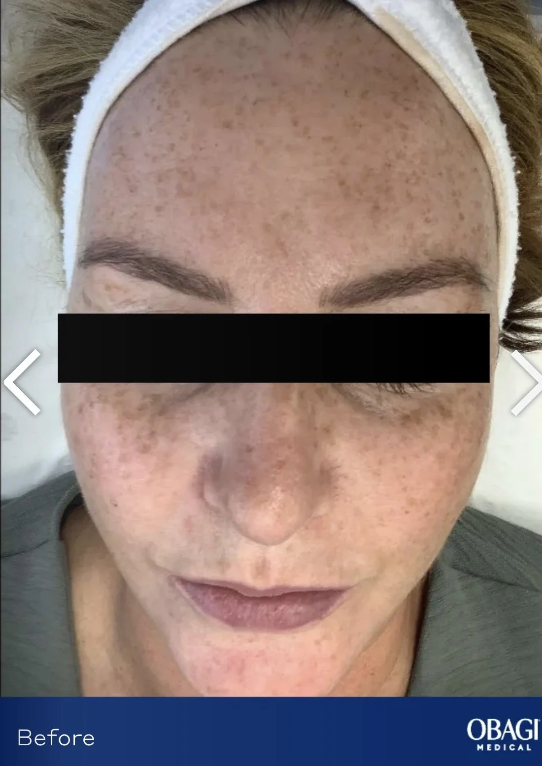 Close-up of a woman's face with freckles before a skincare treatment, wearing a headband, with her eyes closed.