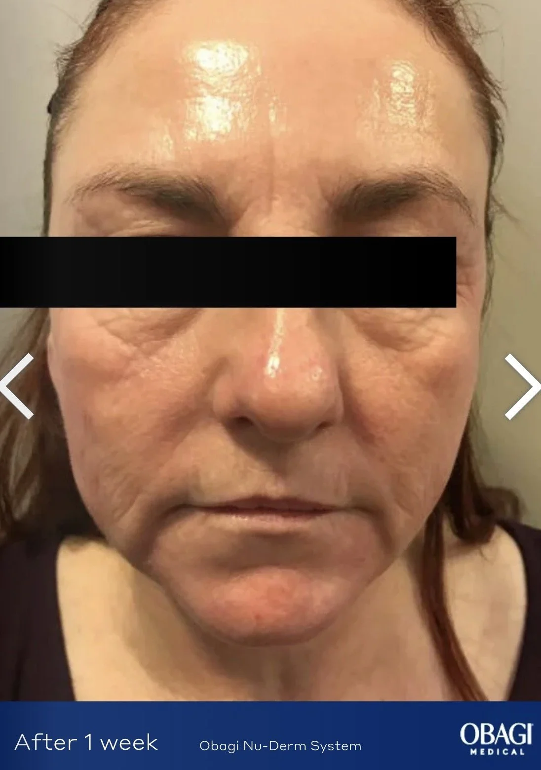 Close-up of a woman's face showing skin improvements after one week of using Obagi Nu-Derm System, with a black bar covering her eyes.