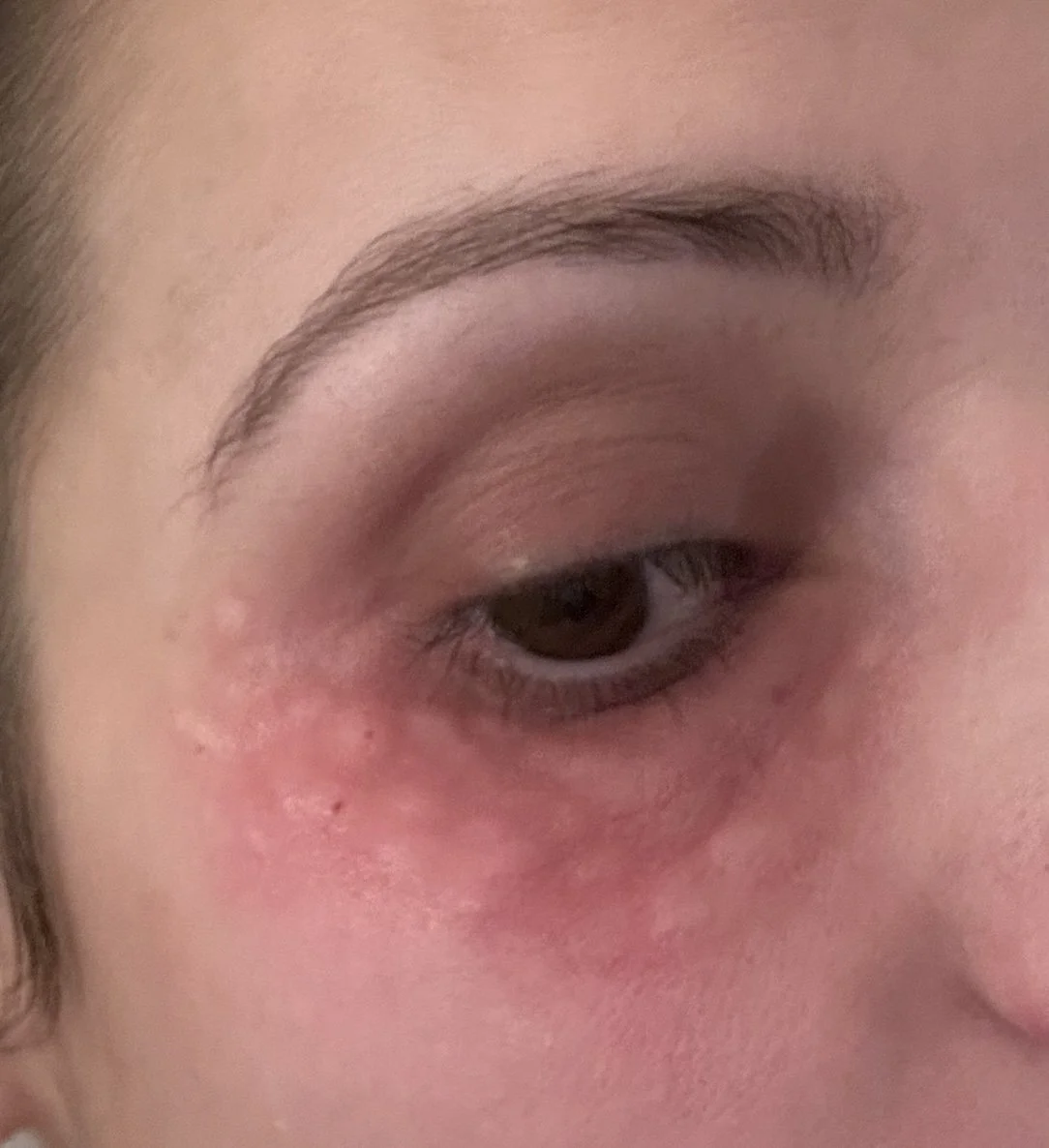 Close-up of the blebs post treatment on a page about polynucleotide treatments by dr caroline warden GP and aesthetic doctor in her doctor led clinic in hale, altrincham/south manchester