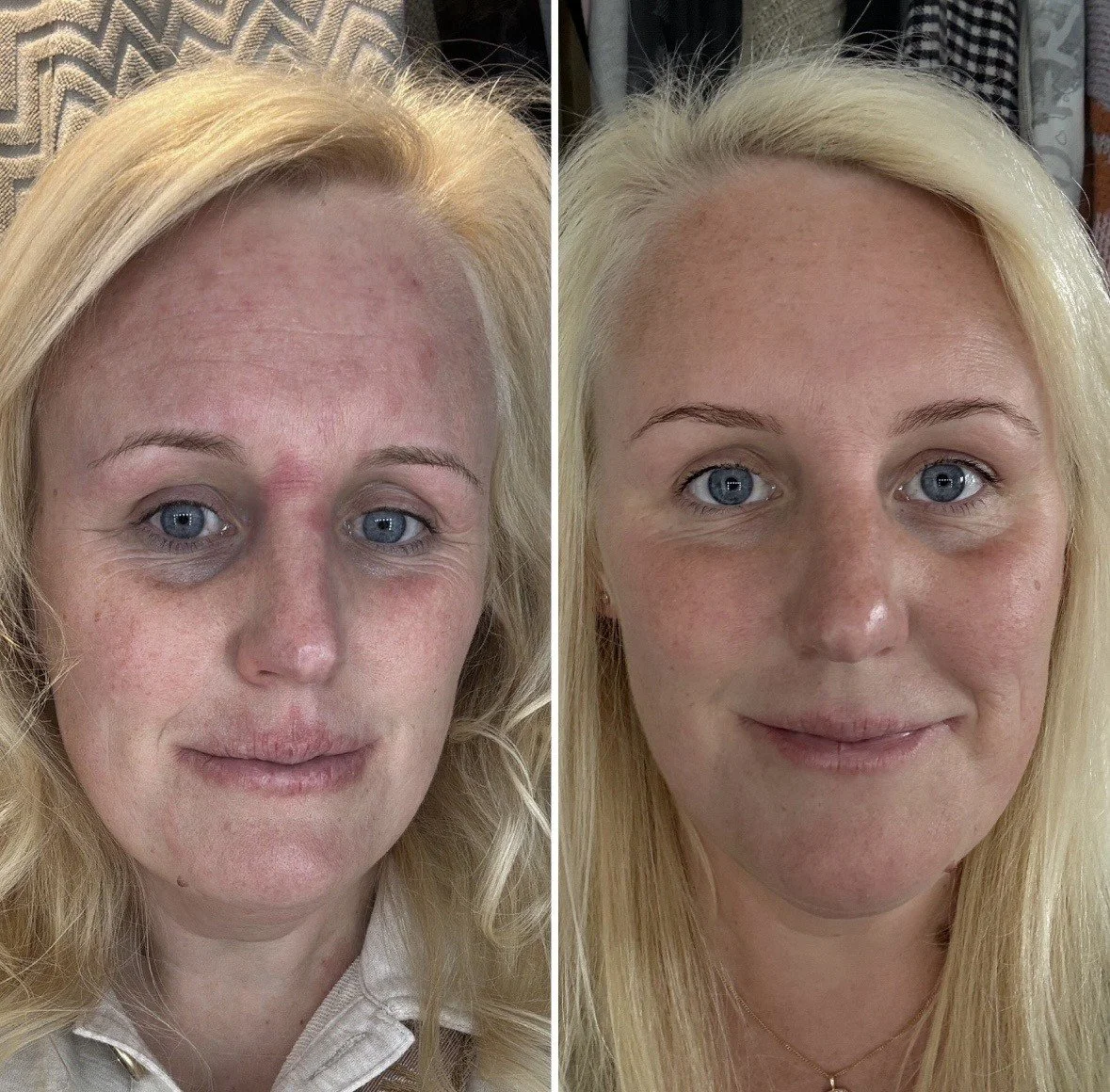 Before and after medical-grade skin barrier repair plan showing calmer, more even-looking skin
