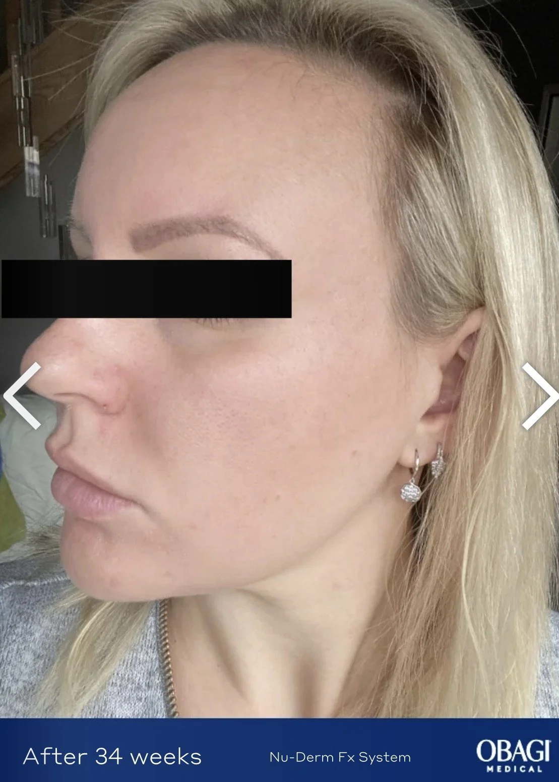 Close-up of a woman's face showing skin improvement after 34 weeks of treatment with the Nu-Derm Fx System by OBAGI Medical, with her left cheek and ear visible.
