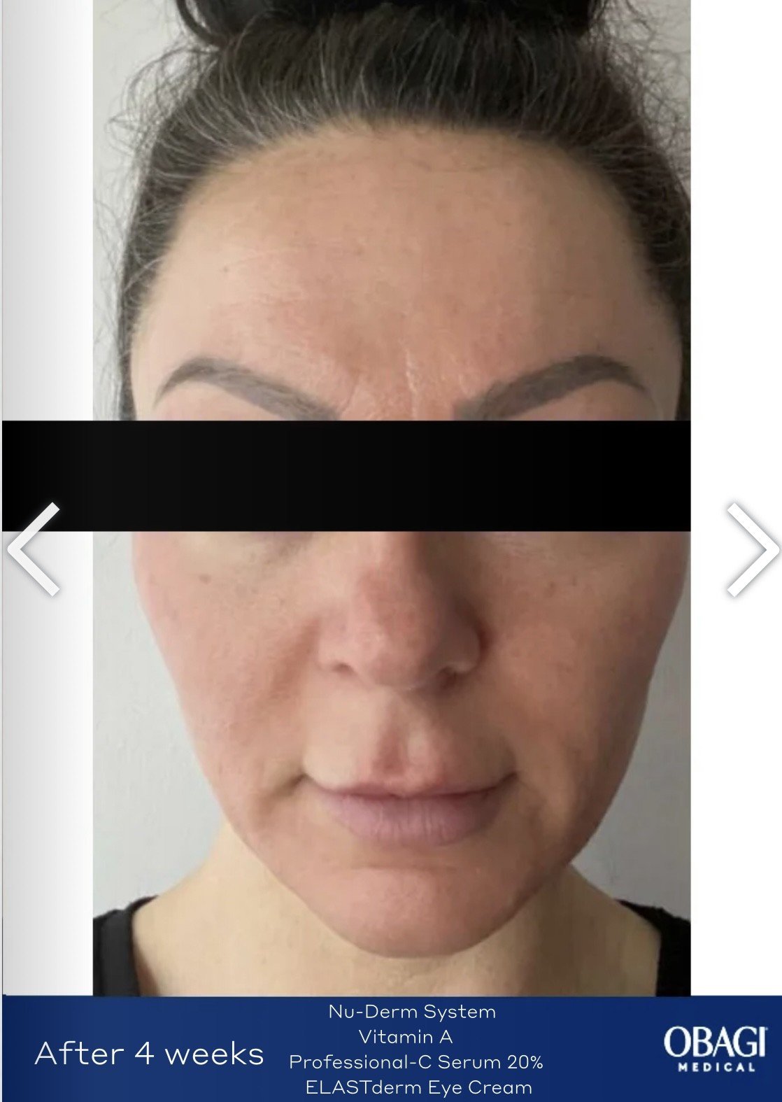 Side-by-side comparison of a woman's face before and after 4 weeks of using Obagi Medical Nu-Derm System, Vitamin A, Professional-C Serum 20%, and ELASTerm Eye Cream, with visible improvements in skin clarity and texture.