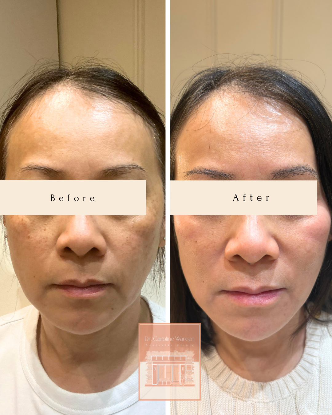 Before and after Obagi Nu-Derm showing reduced facial pigmentation and a more even skin tone