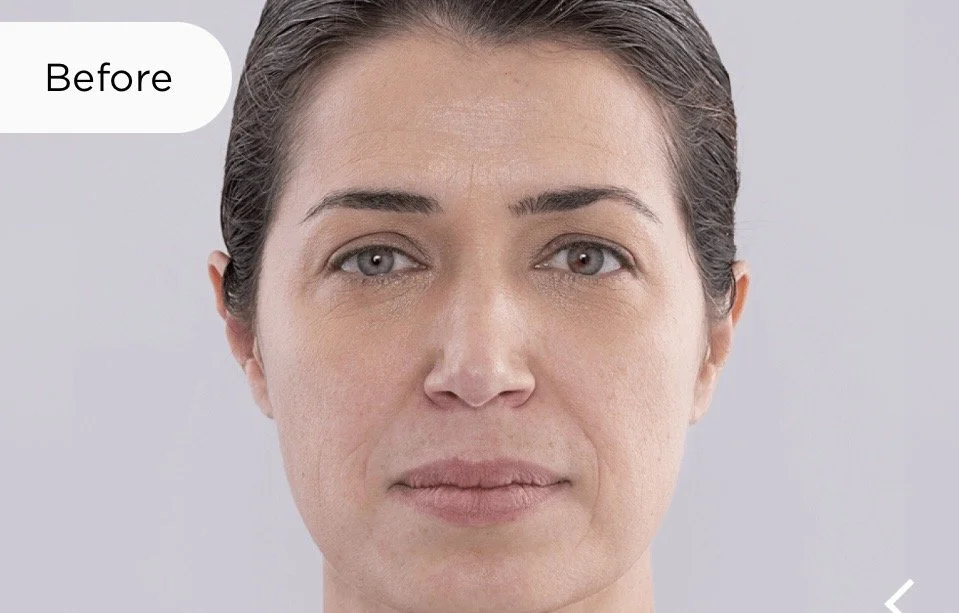 After Sculptra 
