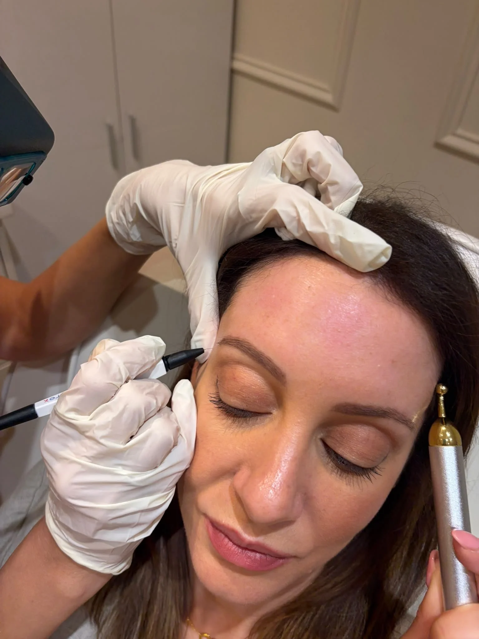 Dr Caroline Warden doing advanced electrocautery to treat a milia on a patient