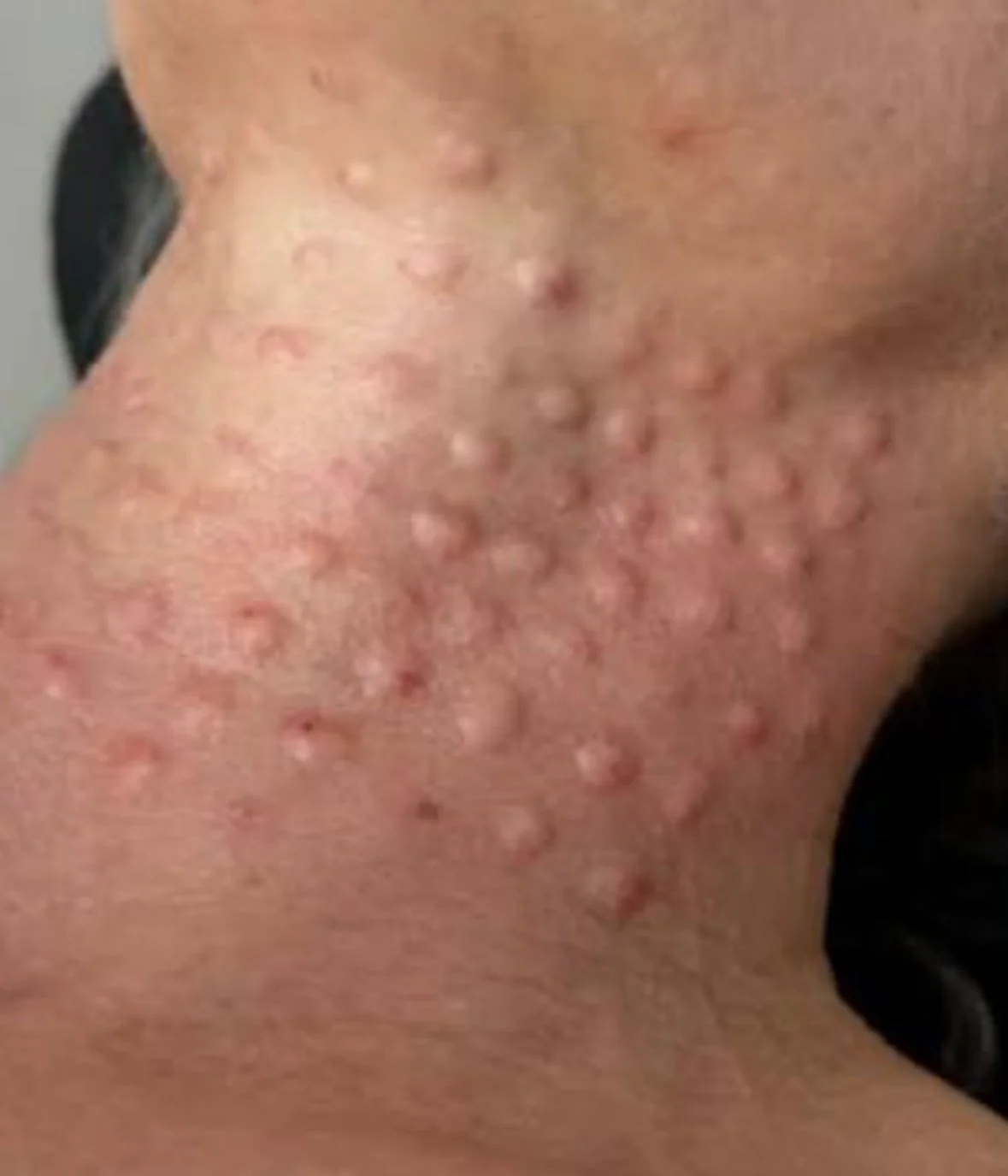 Close-up of the blebs post treatment on a page about polynucleotide treatments by dr caroline warden GP and aesthetic doctor in her doctor led clinic in hale, altrincham/south manchester