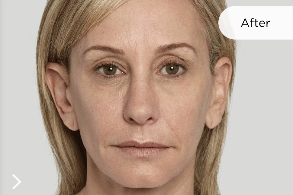 After Sculptra 