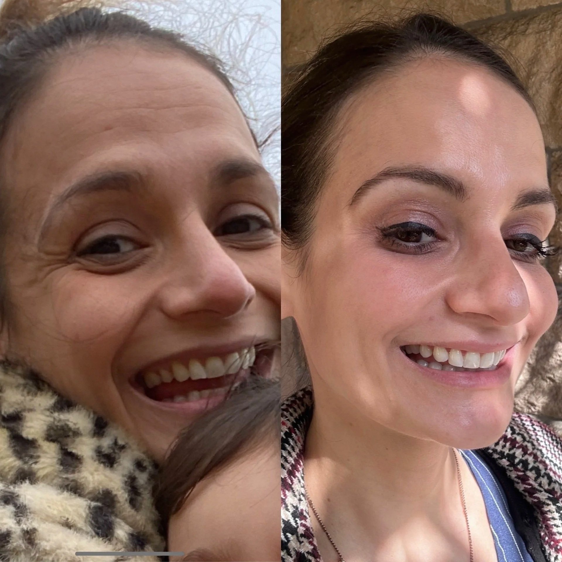 Before and after showing natural-looking changes in skin quality and facial appearance over several years