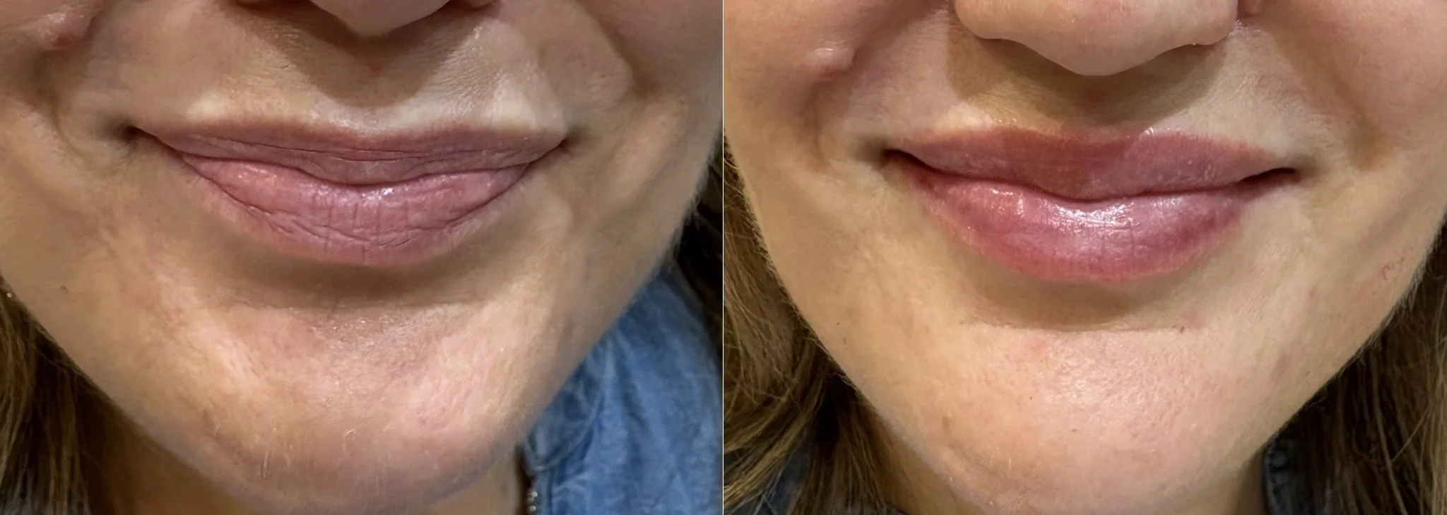 Close-up comparison of a person's lips before and after a cosmetic treatment, showing smoother and more hydrated lips on the right.