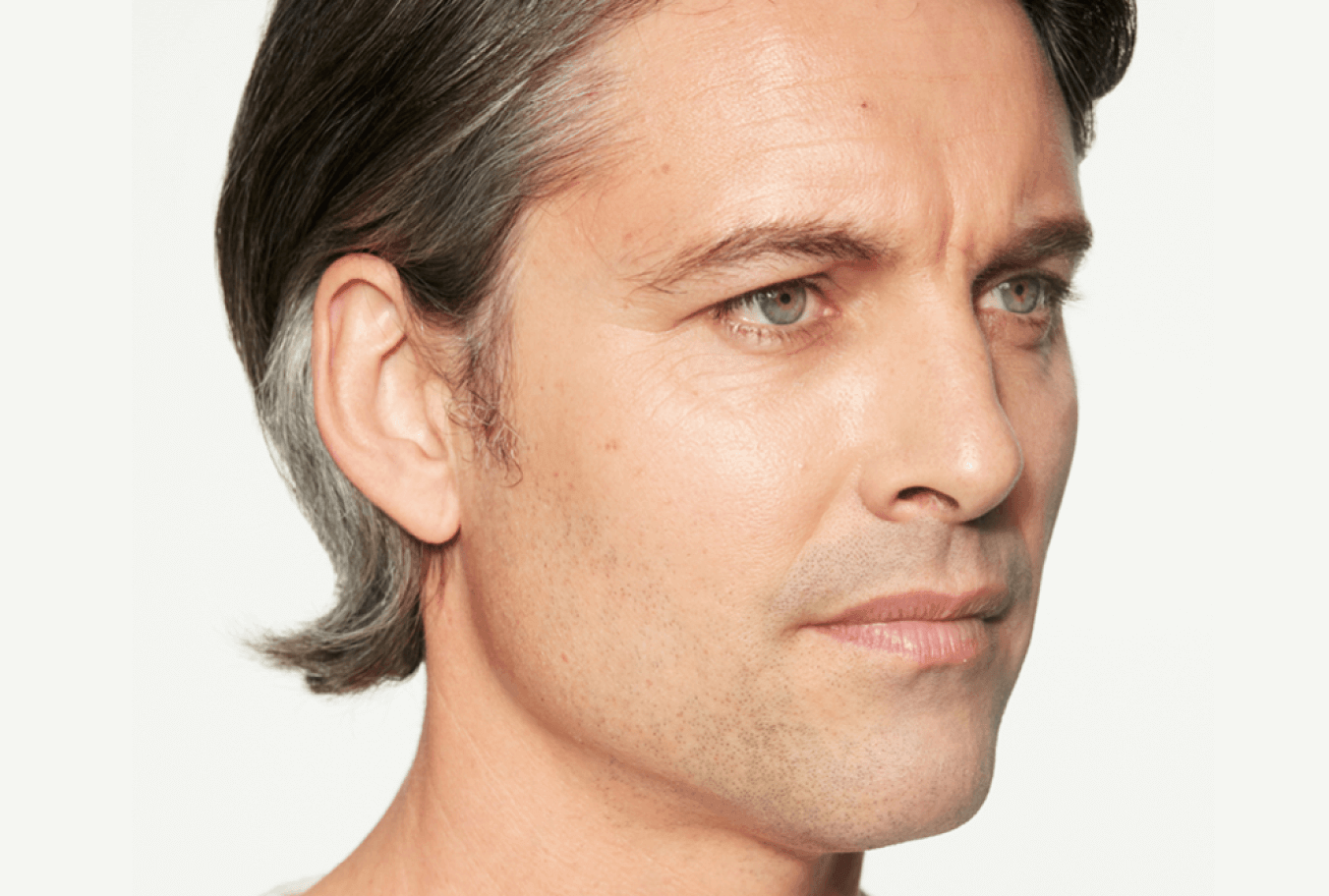 Christian aged 44. Before Sculptra