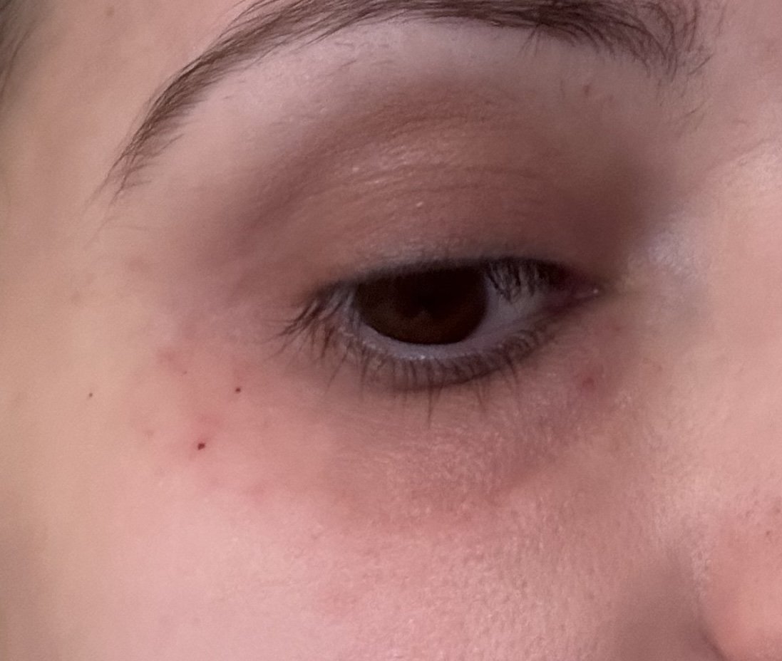 Close-up of the blebs post treatment on a page about polynucleotide treatments by dr caroline warden GP and aesthetic doctor in her doctor led clinic in hale, altrincham/south manchester