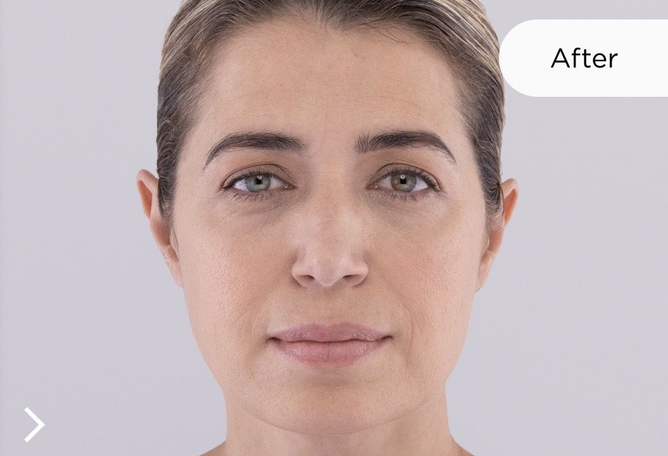 Before Sculptra 