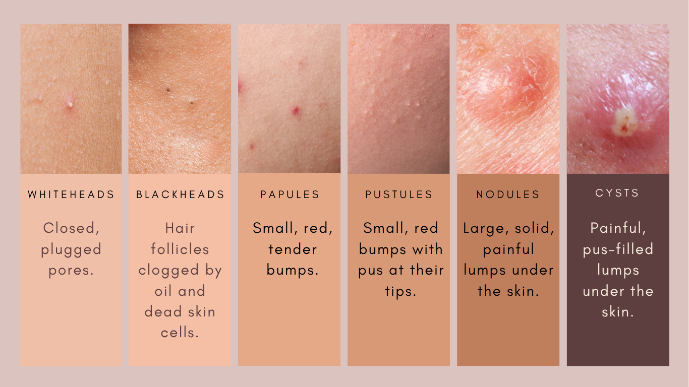 Skin Type Guide | Identify Your Skin Type Today — Dr. Caroline Warden ...