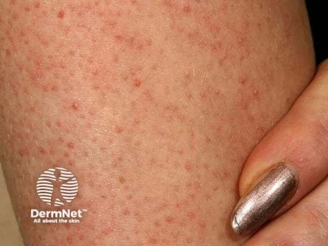 Keratosis Pilaris: The “Chicken Skin” Condition That Isn’t Just Dry Skin