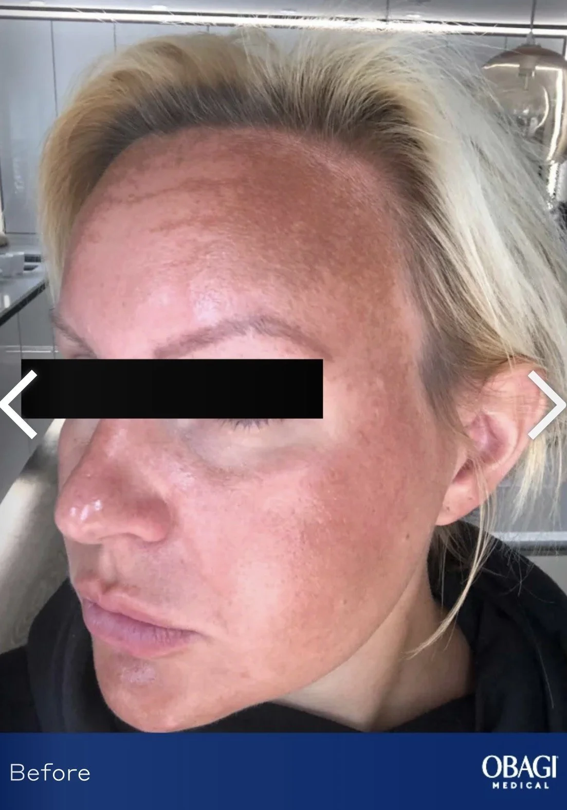 Close-up of a woman's face before skin treatment, showing uneven and textured skin with redness and pigmentation, in a medical setting.