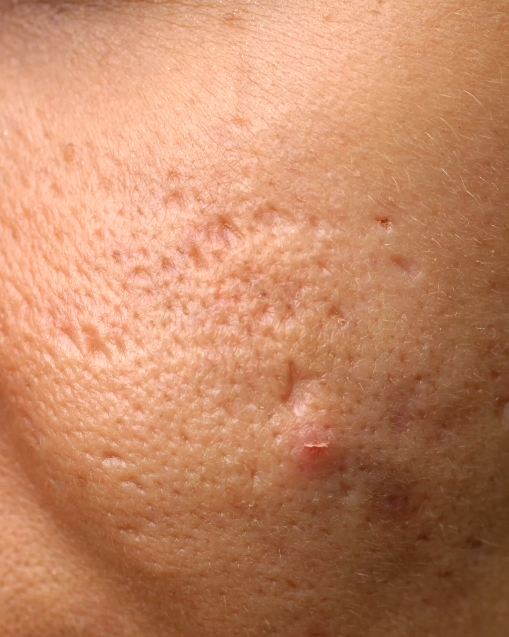 Can Acne Scars Be Removed Permanently? A GP and Aesthetic Doctor's Guide to Acne Scar Treatment in Hale, Altrincham and Cheshire