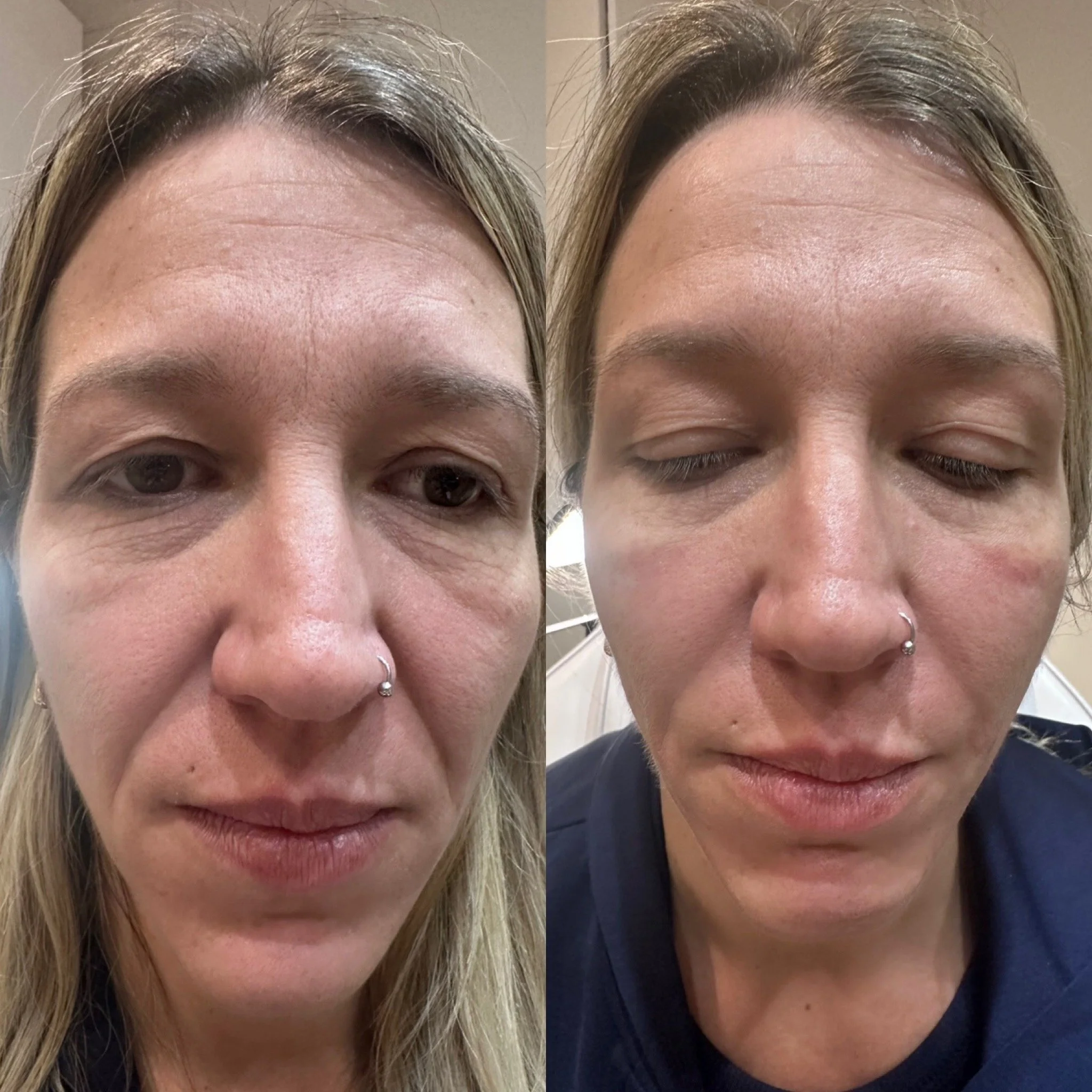 Side-by-side comparison of a woman's face before and after skincare, showing reduced signs of aging and improved skin texture.