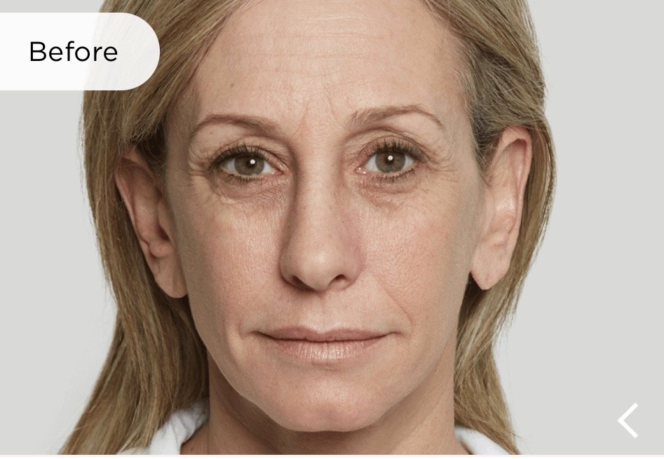 Before Sculptra