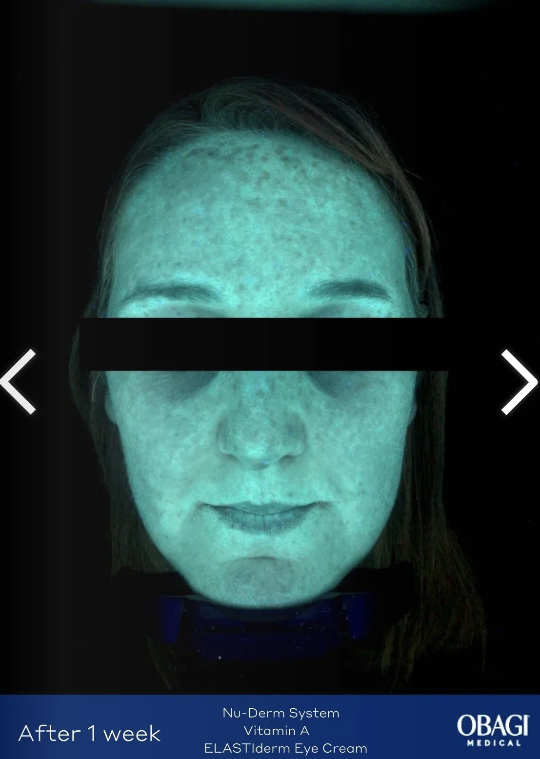 Close-up of a woman's face with freckles, shown under UV light, with the upper half of her face obscured by a black bar, indicating a skincare treatment follow-up after one week using OBAGI medical products.