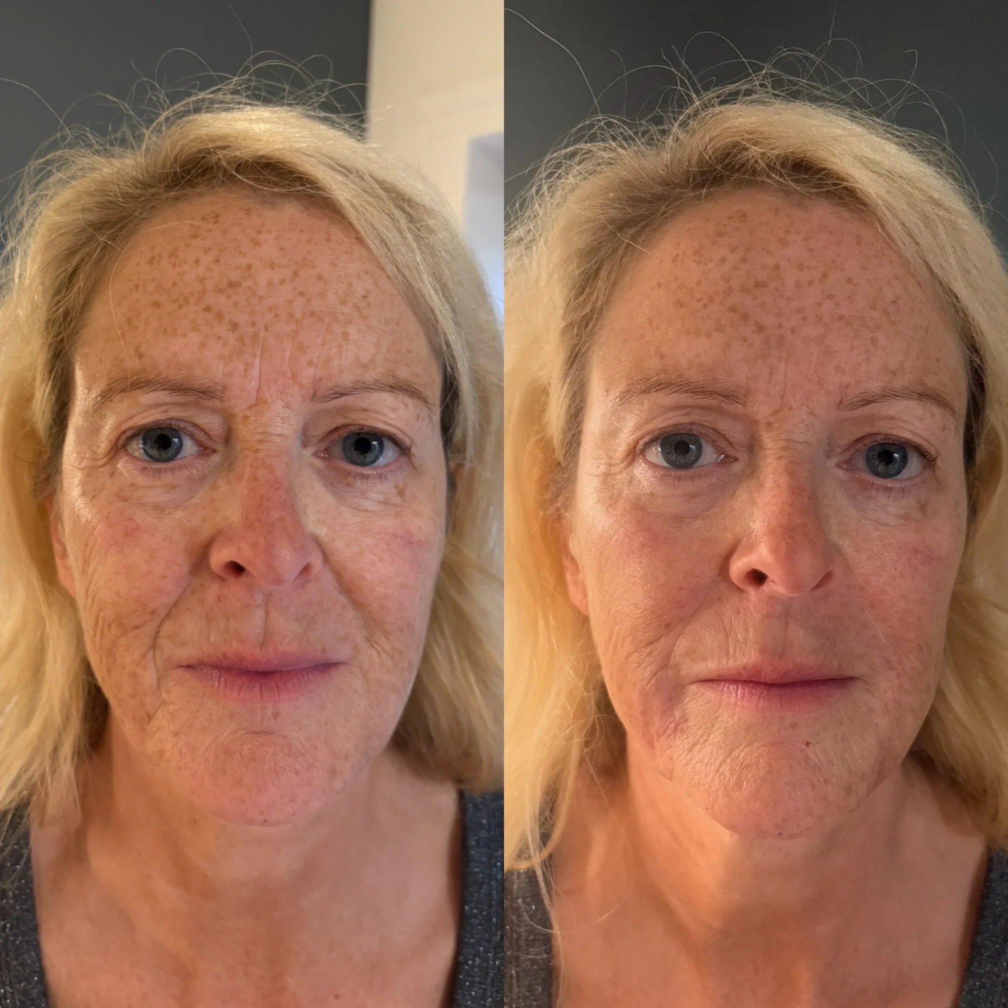 Side-by-side comparison of a woman's face before and after skincare, showing reduced pigmentation and smoother skin texture on the right.