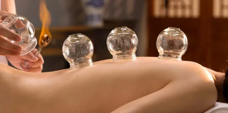 A person receiving cupping therapy with three glass cups placed on their back.