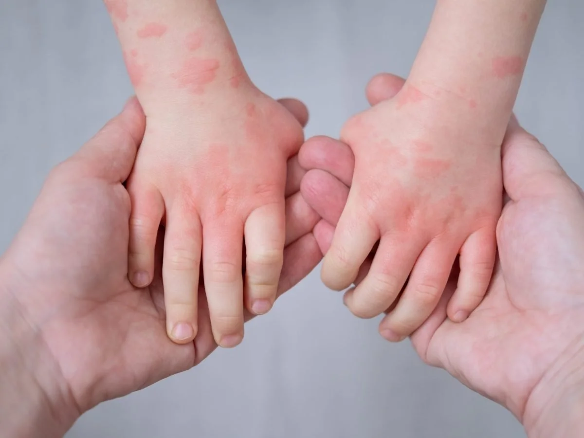 The Gut-Skin Connection: Why Your Toddler's Eczema and Constipation May Be Linked
