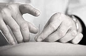 Rethinking Dry Needling: A Nervous System Perspective