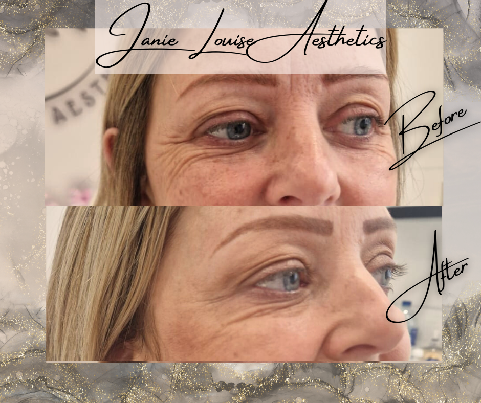 Before and after comparison of a facial aesthetics treatment, featuring two close-up images of a woman's eye area, with reduced wrinkles and tighter skin in the 'after' image, branded with "Janie Louise Aesthetics".