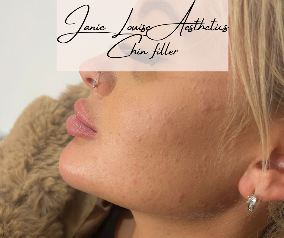 Side profile of a person with chin filler and text overlay 'Janie Louise Aesthetics Chin filler', wearing a nose ring and earring.