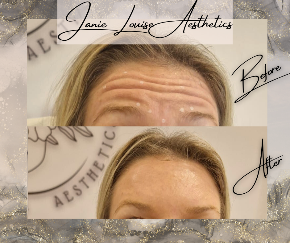 Before and after shots of a person's forehead showing aesthetic treatment results. The top image shows visible wrinkles, and the bottom image shows a smoother forehead. Background text includes "Janie Louise Aesthetics" and "Before" and "After" label