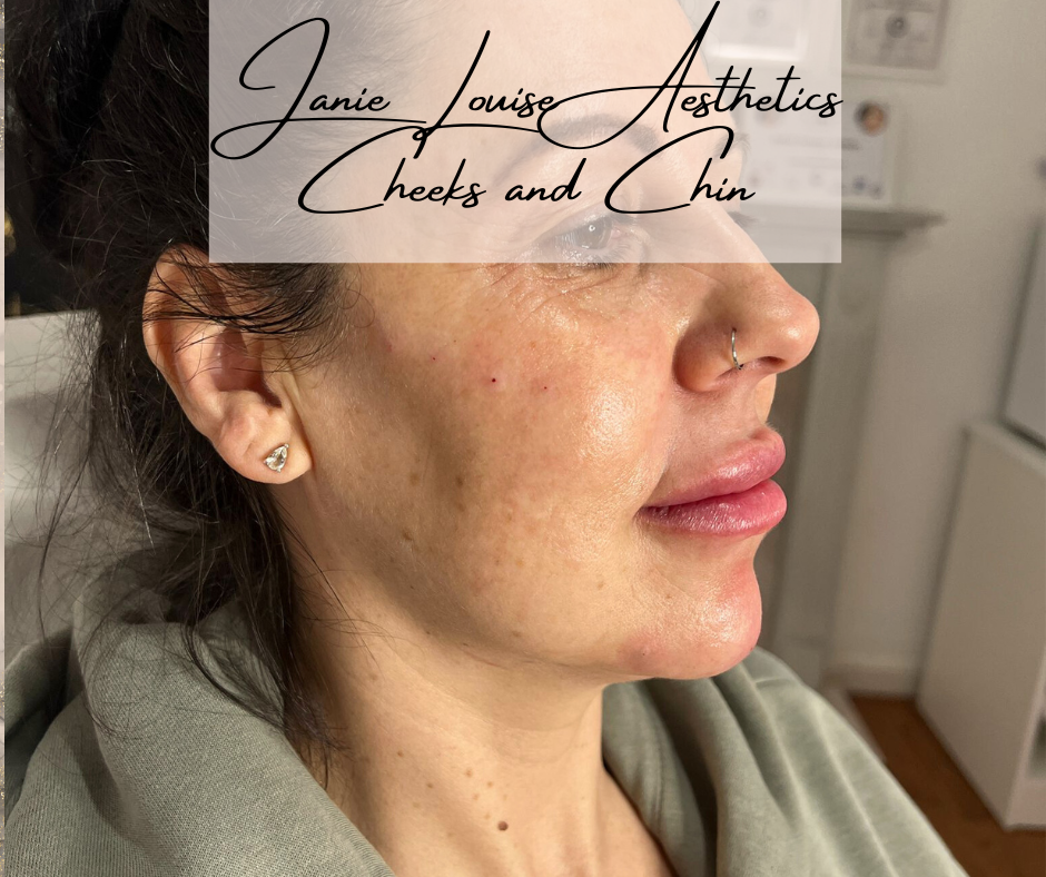 Side profile of a woman with clear skin, wearing a nose ring and earring, text overlay "Janie Louise Aesthetics Cheeks and Chin."