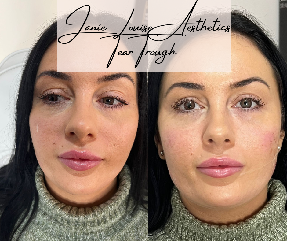 Tear trough treatment before and after photos, female client, aesthetic procedure results.