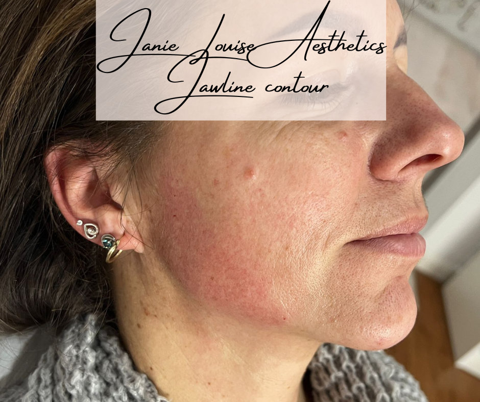 Side view of person showcasing jawline contour at Janie Louise Aesthetics.
