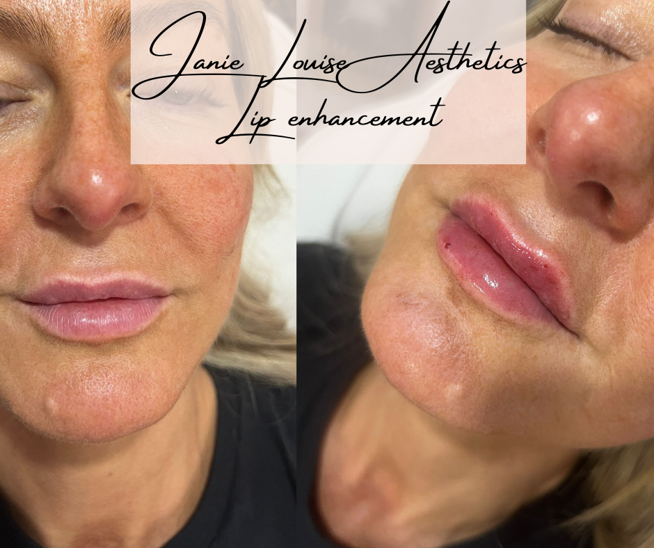 Lip enhancement before and after close-up images with "Janie Louise Aesthetics Lip Enhancement" 