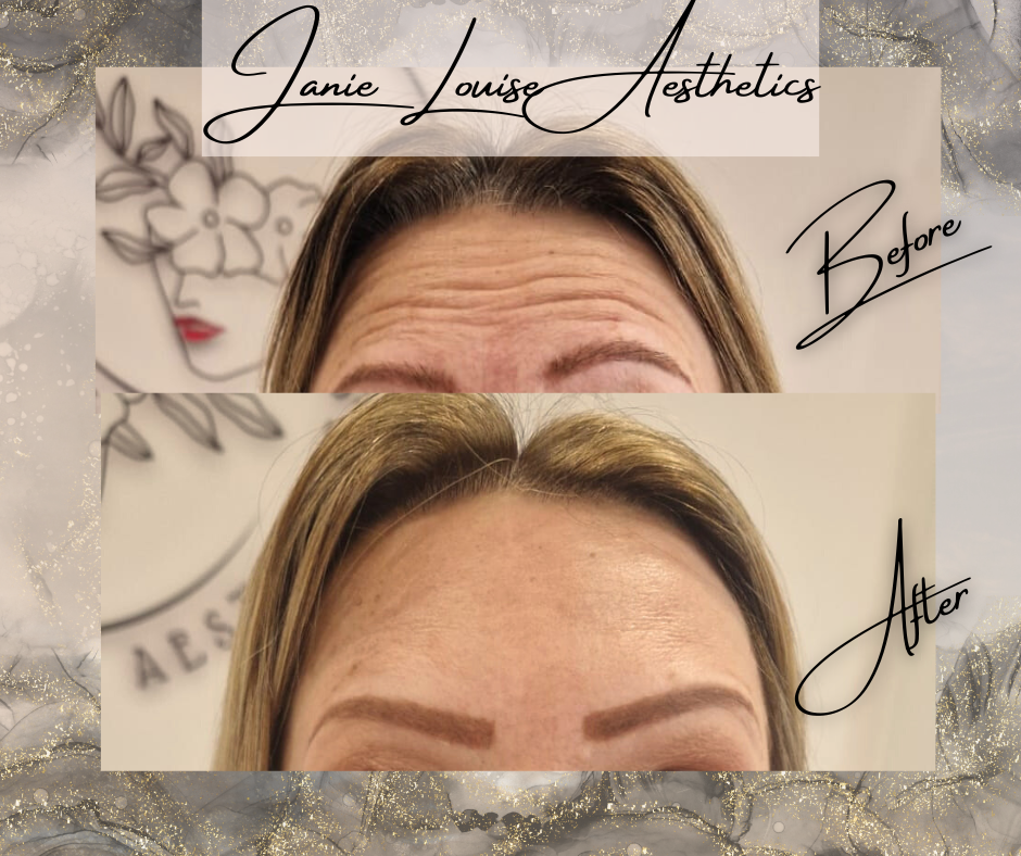 Before and after forehead wrinkle reduction at Janie Louise Aesthetics.