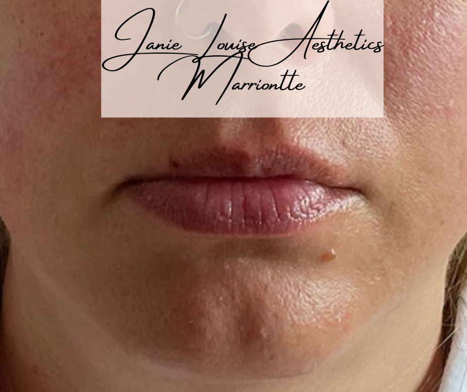 Close-up of a person's chin and lips Janie Louise Aesthetics Mariontte