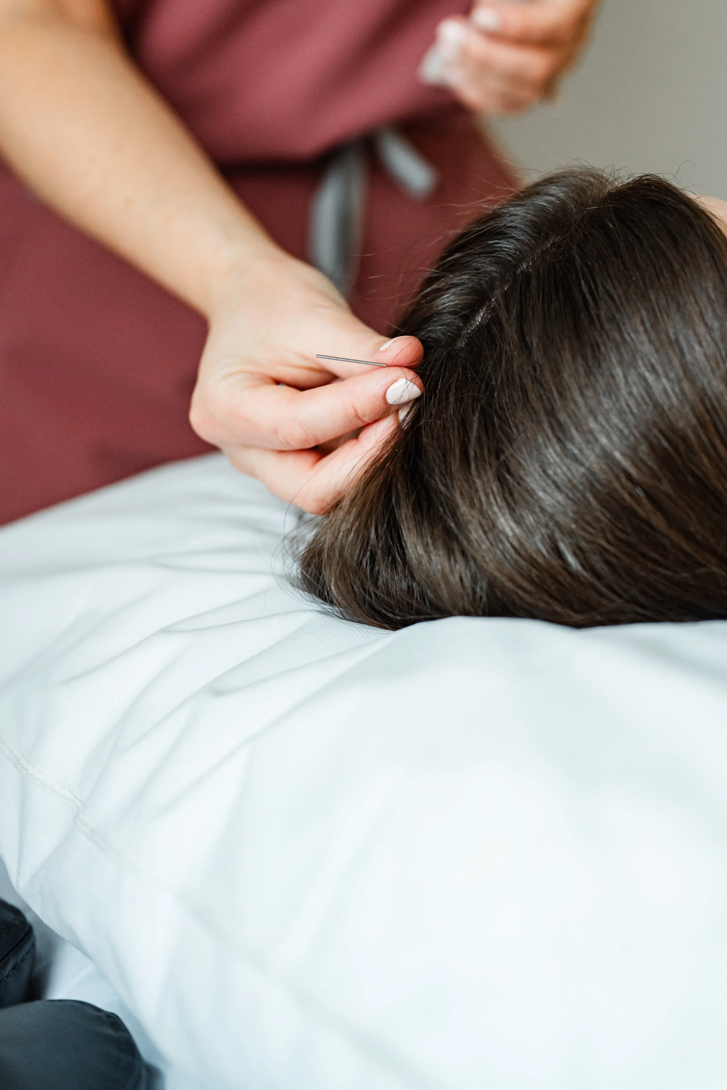 Acupuncturist carefully placing needles along a patient's scalp during a first trimester prenatal acupuncture treatment in Groton, MA