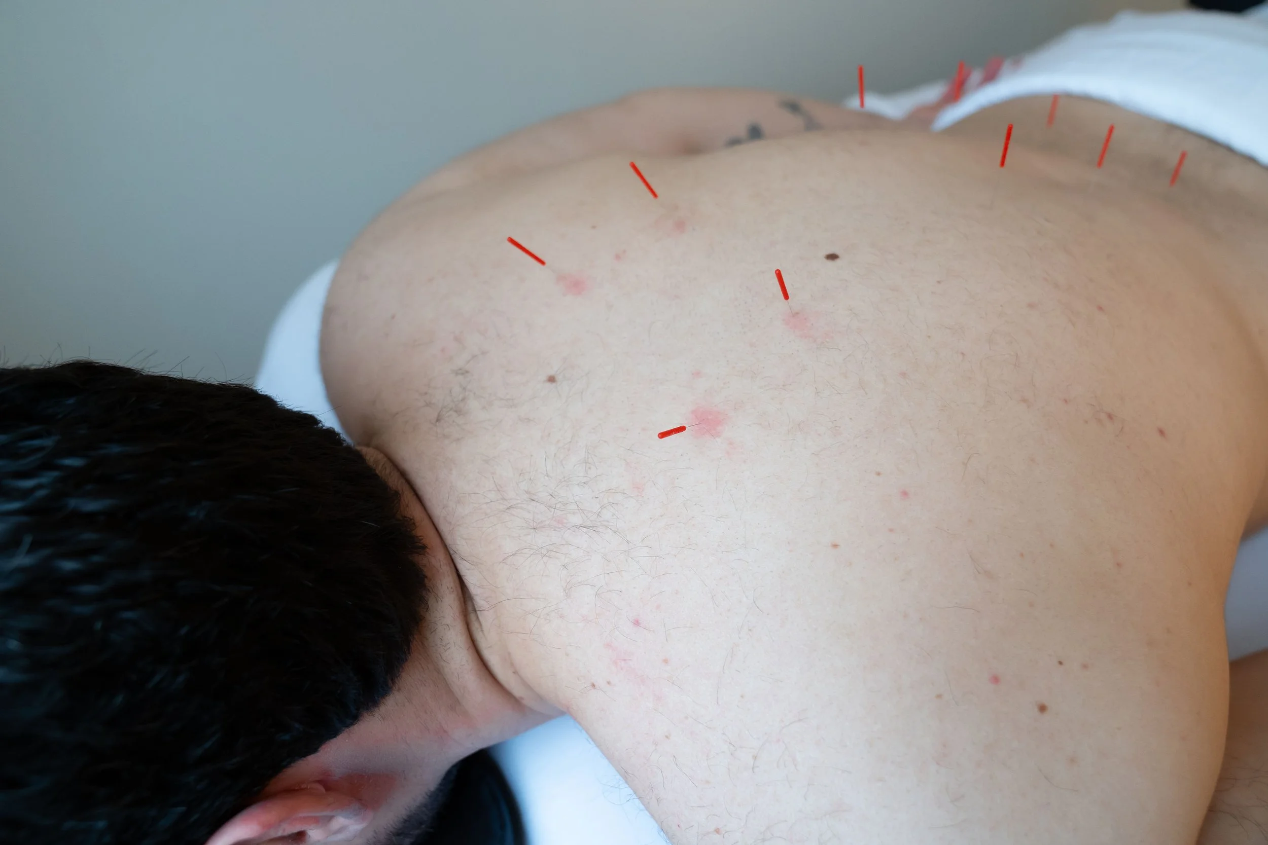 Acupuncture needles placed in the back during a male fertility treatment session
