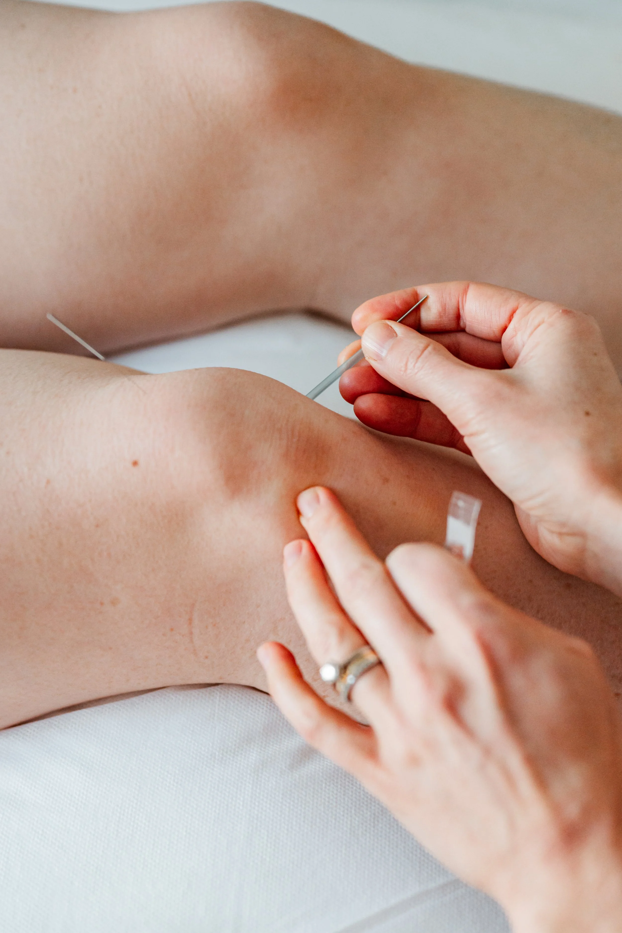 Acupuncture treatment supporting nerve health for neuropathy in Groton, MA