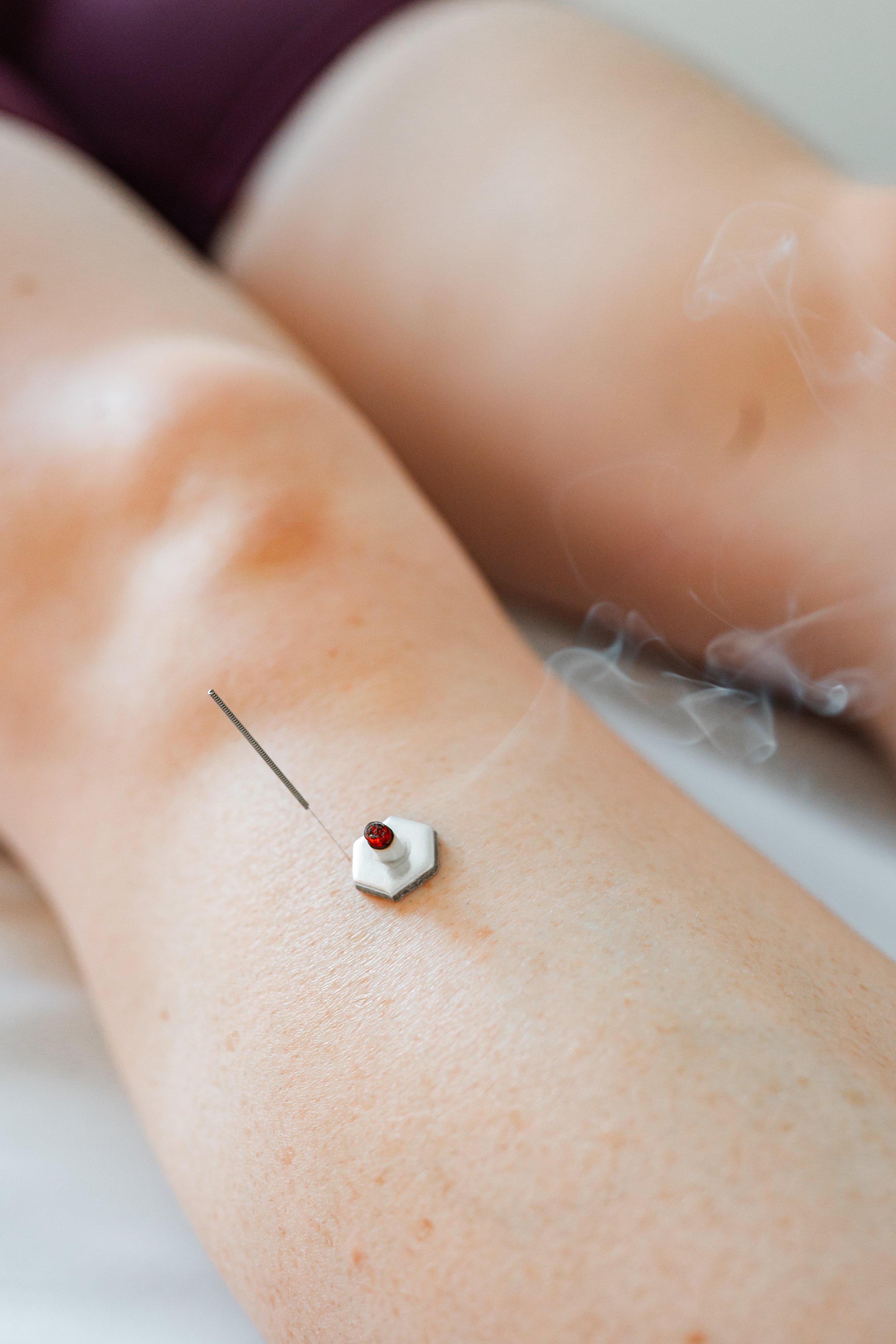 Close-up of a single acupuncture needle placed on a patient's leg during a gentle first trimester pregnancy acupuncture session in Groton, MA