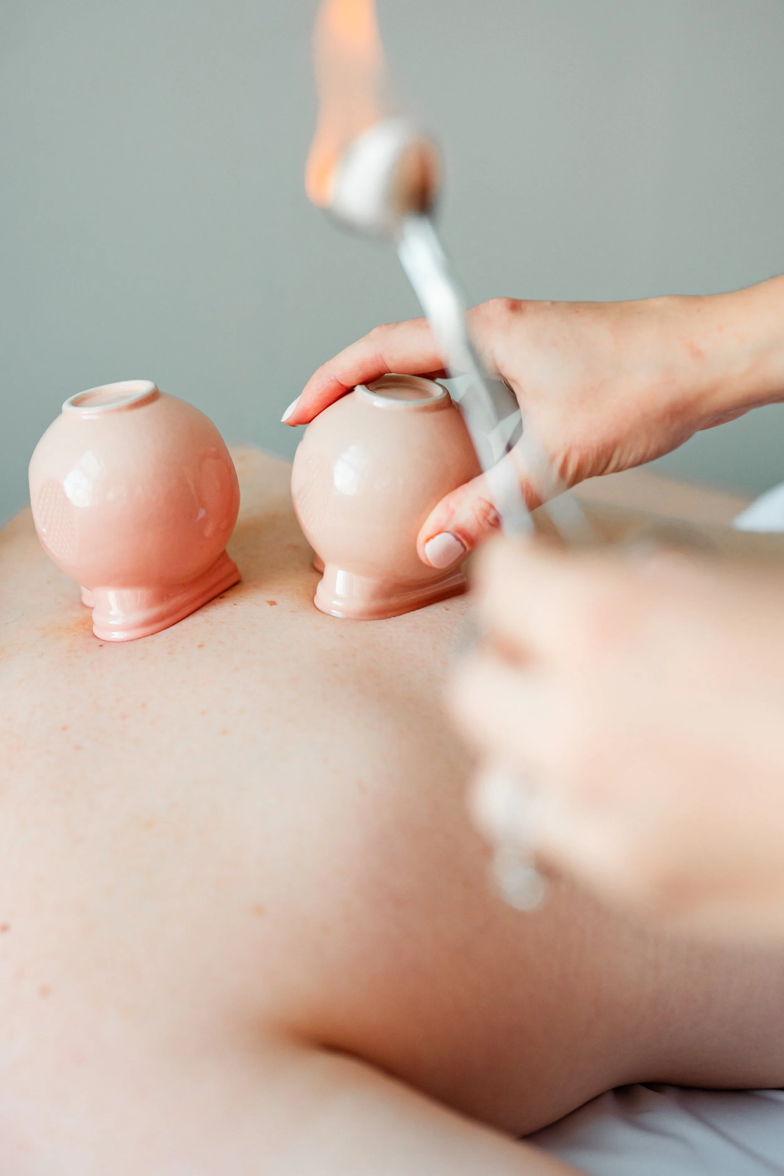 Cupping therapy cups placed on the back to support circulation and recovery alongside acupuncture in Groton, MA