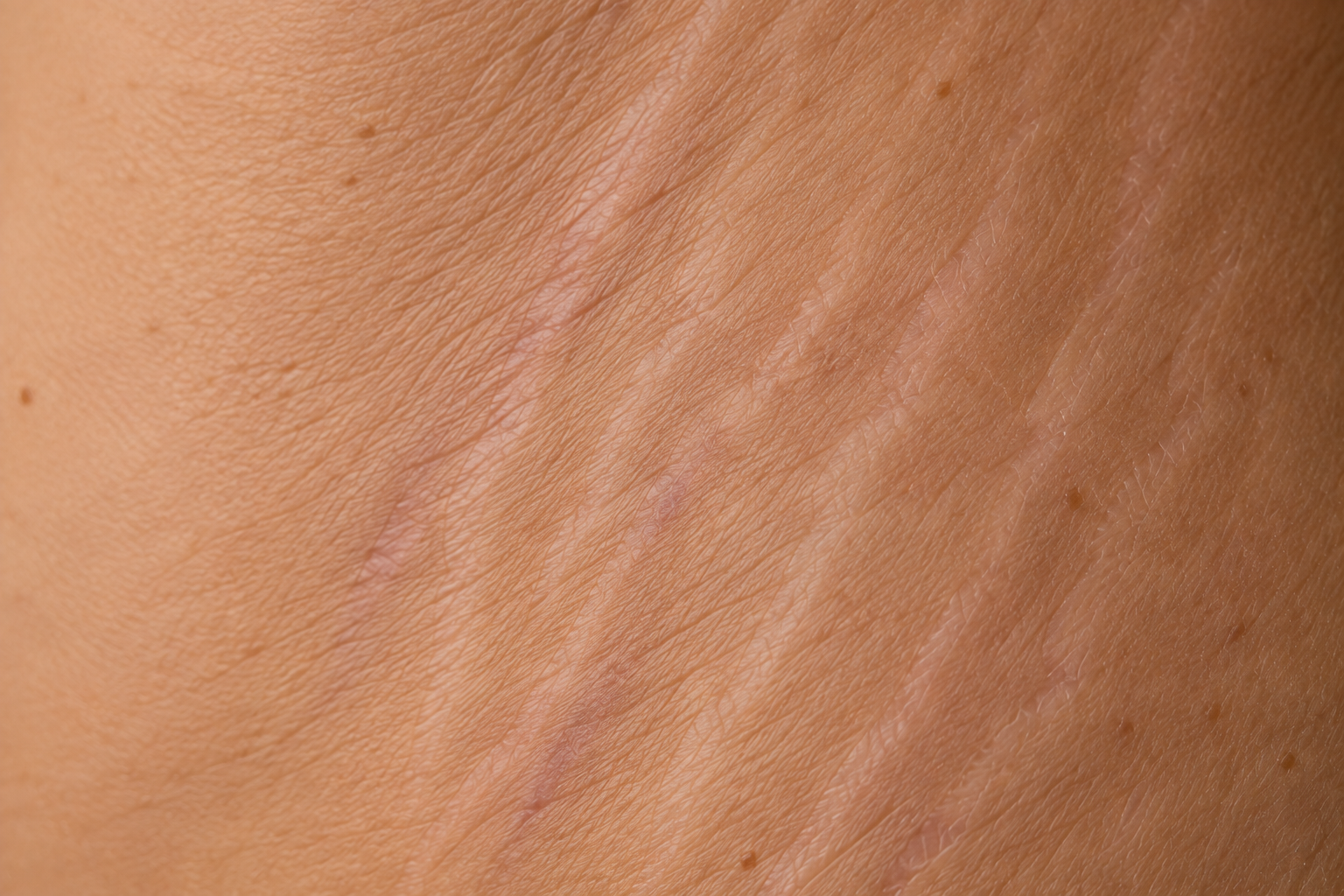 Close-up of stretch marks on the skin