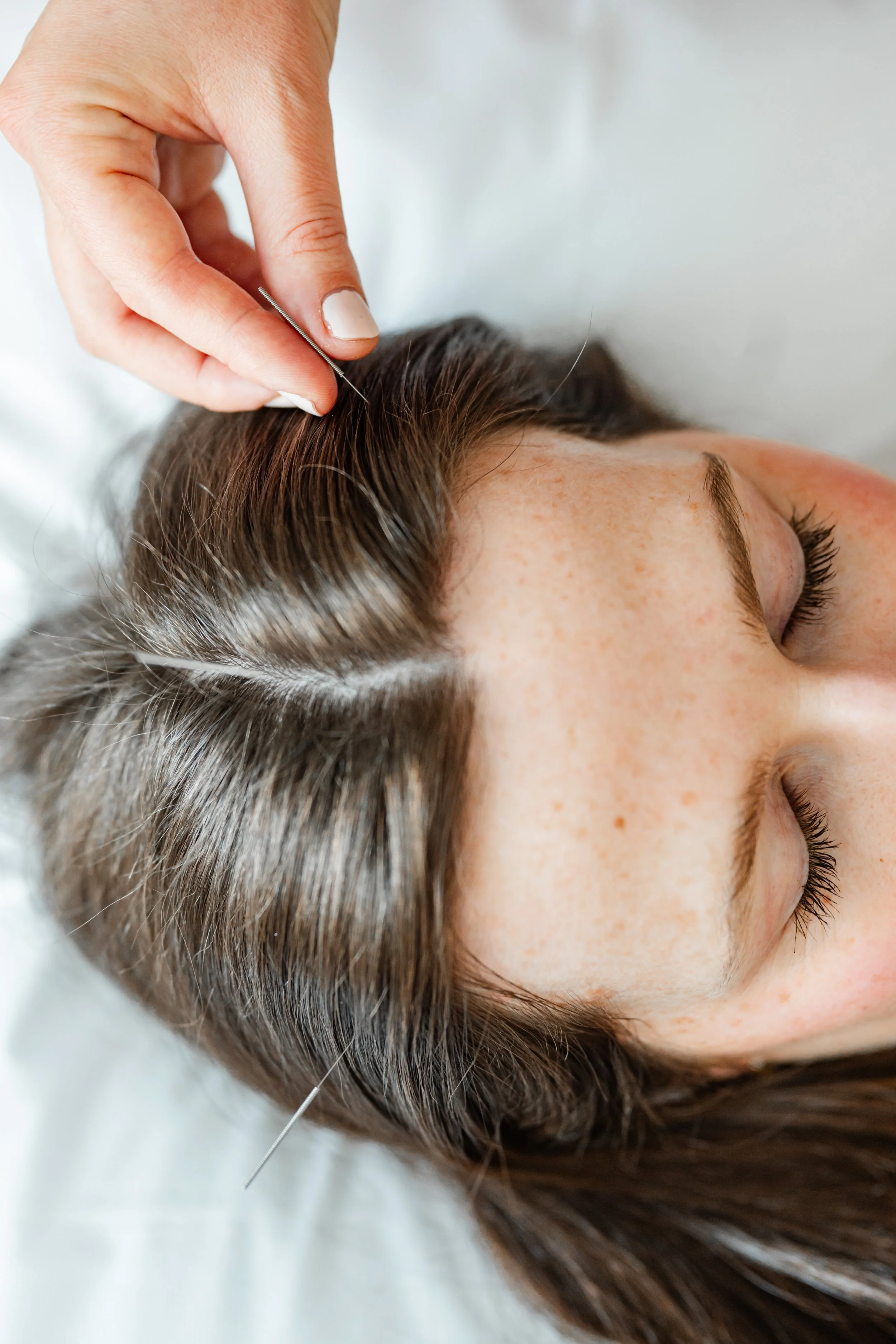Close up of scalp acupuncture treatment for stress relief and women's health in Groton, MA
