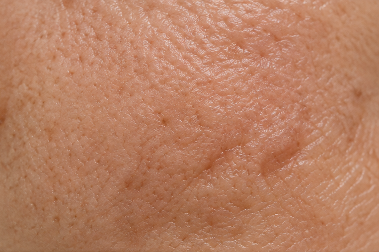 Close-up of uneven skin texture and visible pores