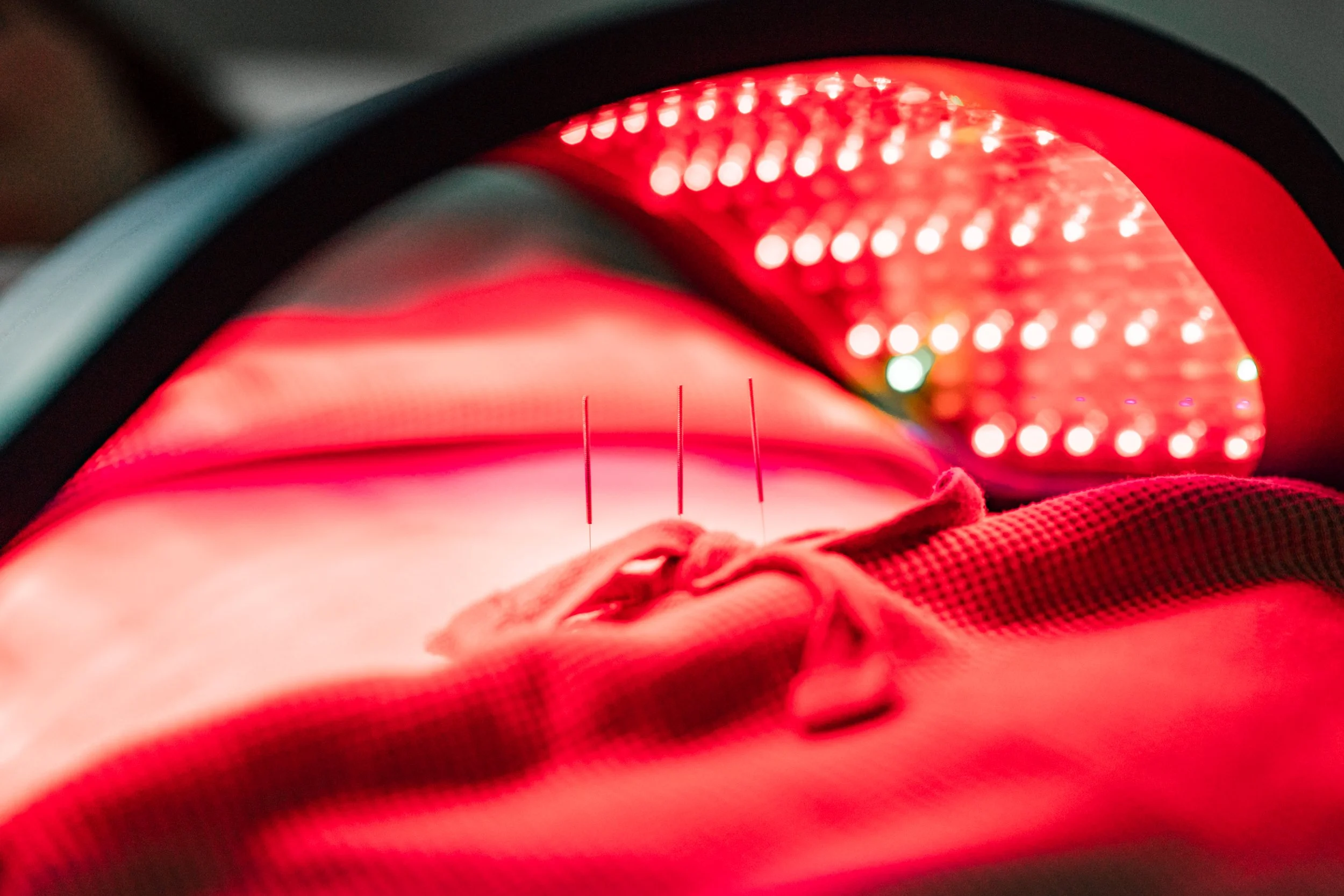 Red light therapy combined with acupuncture for postpartum recovery in Groton, MA