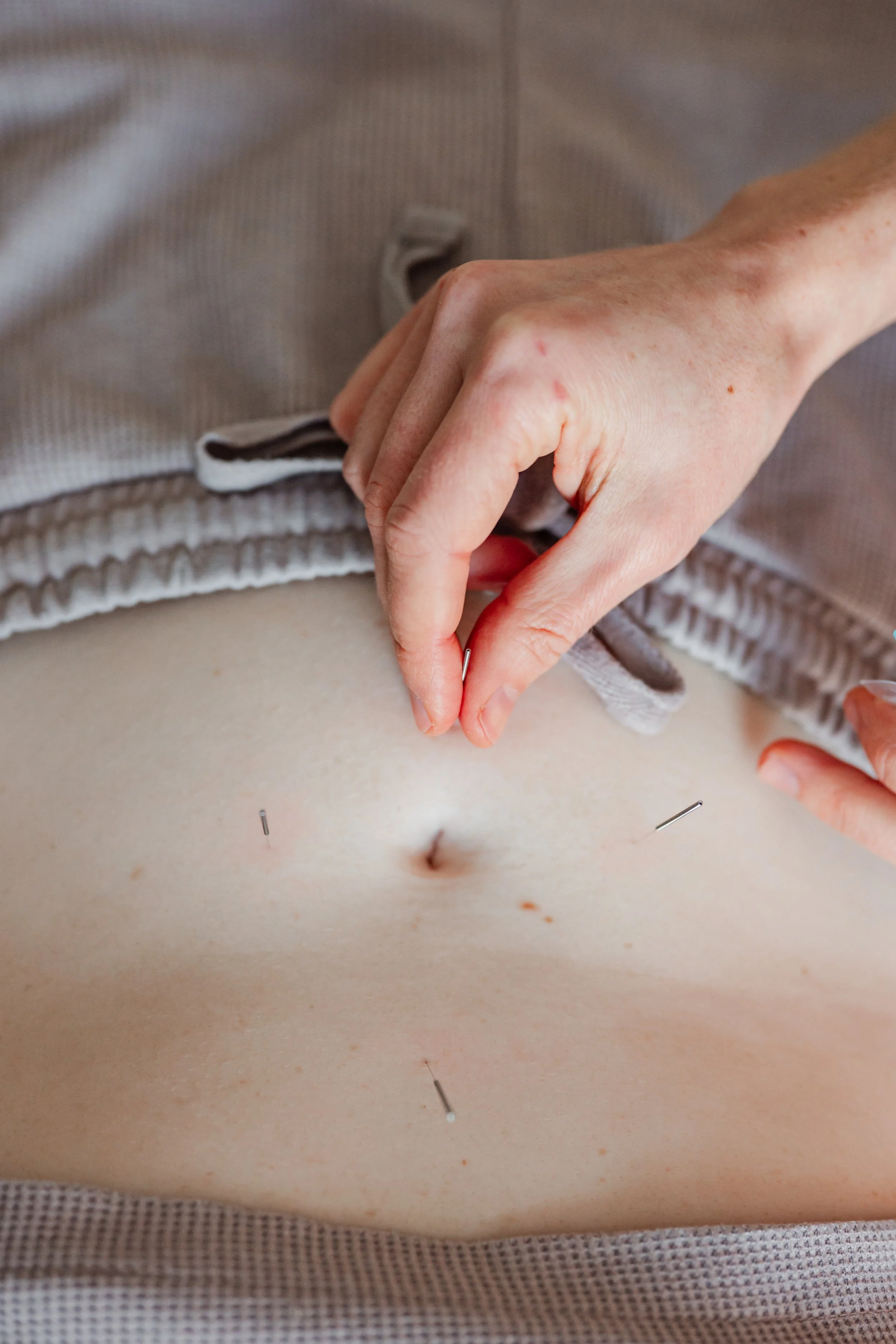 Close-up of acupuncture needles being gently placed on a patient's abdomen during a PCOS treatment session in Groton, MA