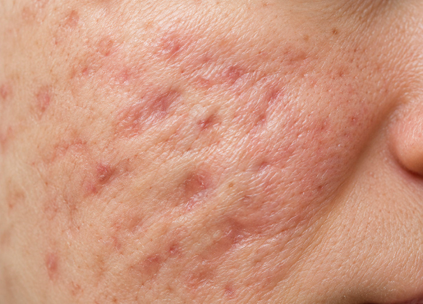 Close-up of facial skin with visible acne scarring